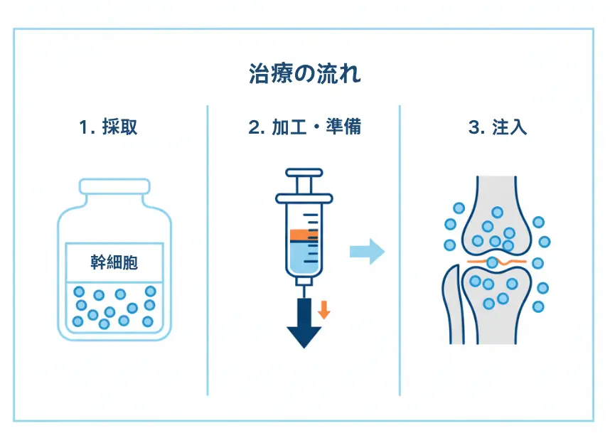 変形性関節症の膝関節に対する幹細胞注射治療の手順を示す図。