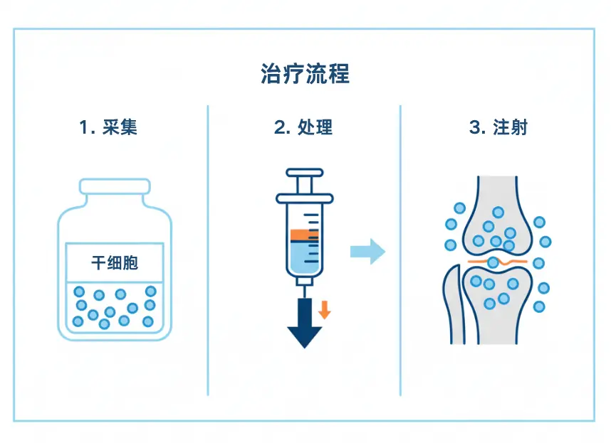 骨关节炎膝关节干细胞注射治疗流程示意图。