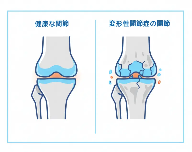 健康な膝関節と変形性関節症の膝関節の医学的比較図。軟骨の退行性変化を示しています。