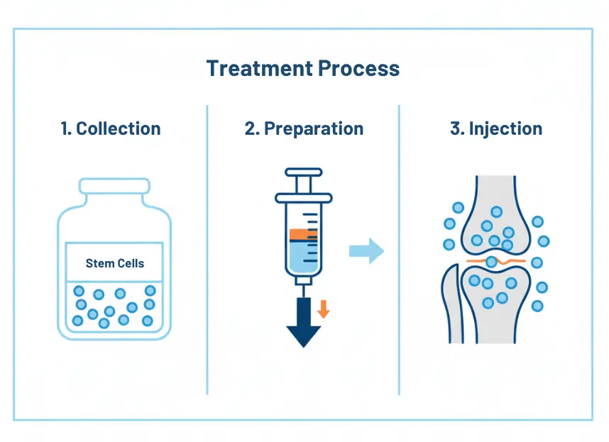 Illustration of the stem cell injection procedure for osteoarthritis treatment in the knee joint.