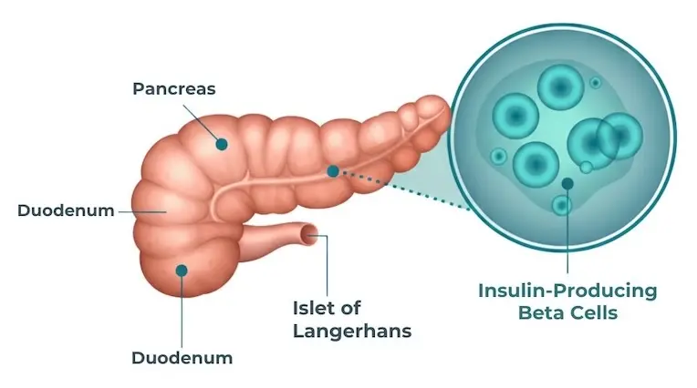 Medical illustration of the pancreas showing insulin-producing beta cells in the islets of Langerhans